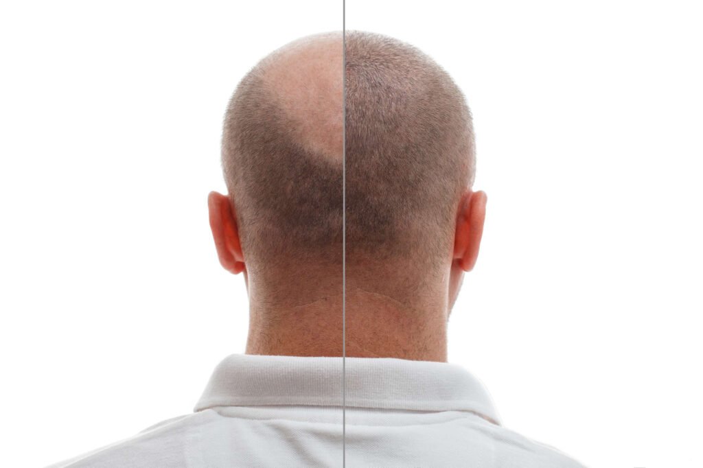 hair transplant